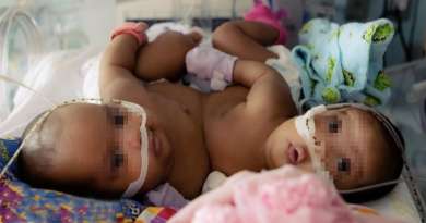 Dos gemelas siamesas son separadas tras operación de 11 horas en EE.UU.