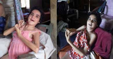 Piden ayuda para joven cubana con rara enfermedad 